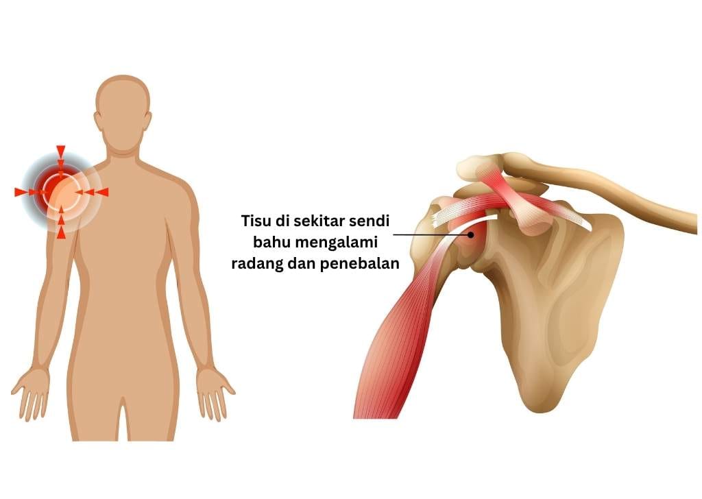 Atasi masalah frozen shoulder anda dengan fisioterapi berkesan daripada pakar di Regenesis Subang Jaya. Klik untuk ketahui rawatan selanjutnya!