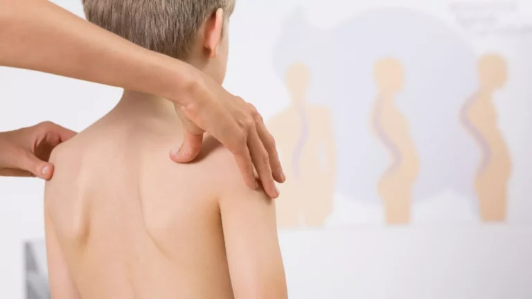 Scoliosis isn’t caused by one single thing - and in most cases, the exact trigger remains unknown. Find out what the experts are saying. | Regenesis Physio