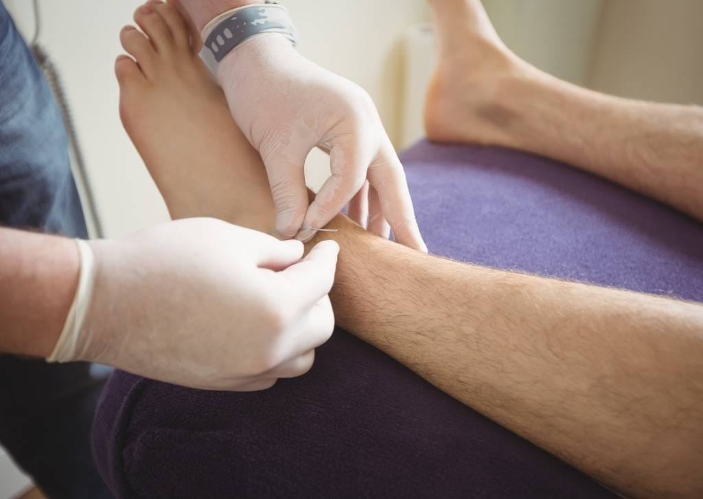 Dry needling is one of the most effective techniques used at Regenesis to reduce pain and inflammation caused by plantar fasciitis.