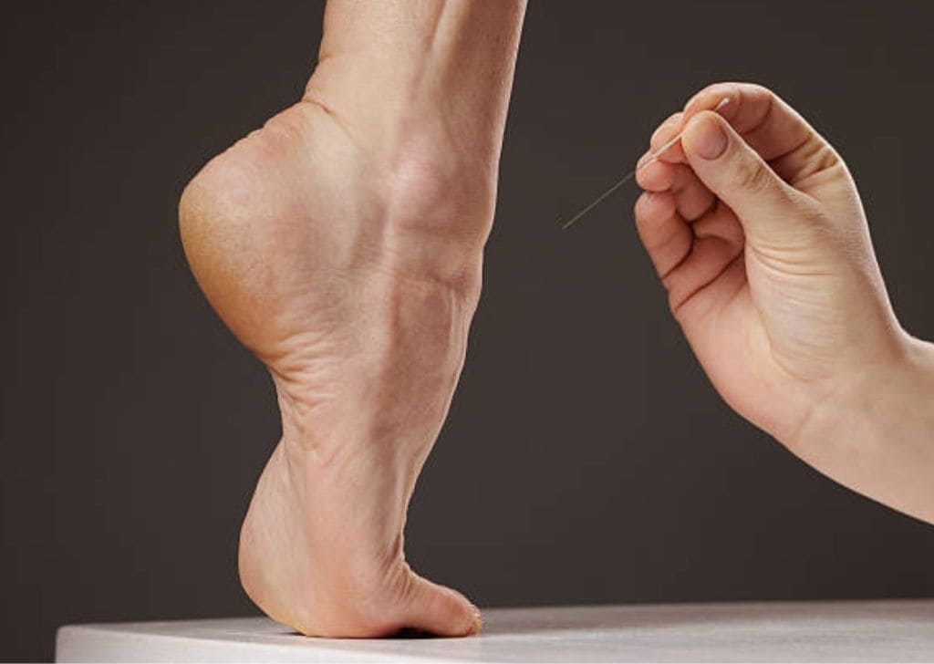 Struggling with heel pain when walking? Discover how dry needling at Regenesis tackles plantar fasciitis from the root. Book treatment in Subang Jaya today.