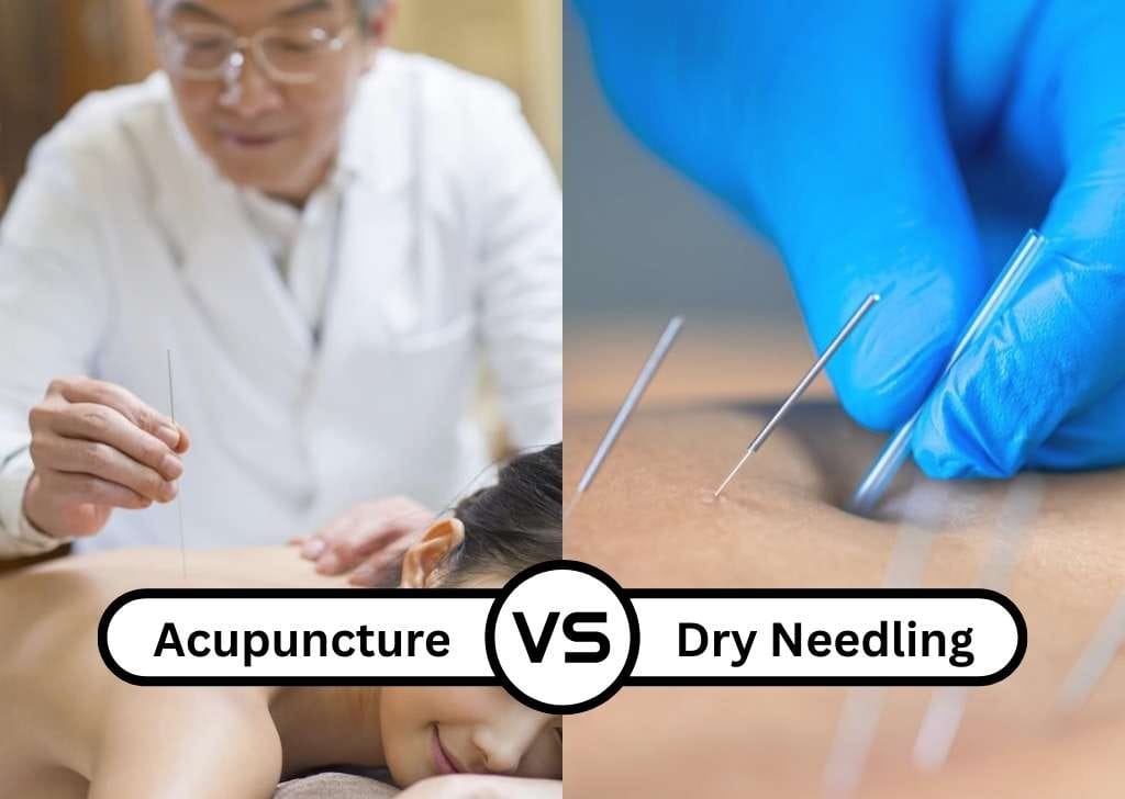 To better understand the differences and determine which treatment suits you best, read our full guide on dry needling vs acupuncture.