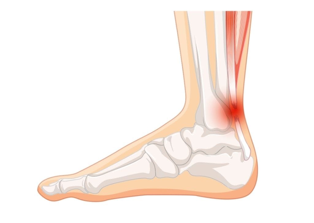 Repeated stress on the plantar fascia—without enough rest or recovery—causes tiny tears in the tissue.
